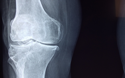 Arthritis? That’s just right…