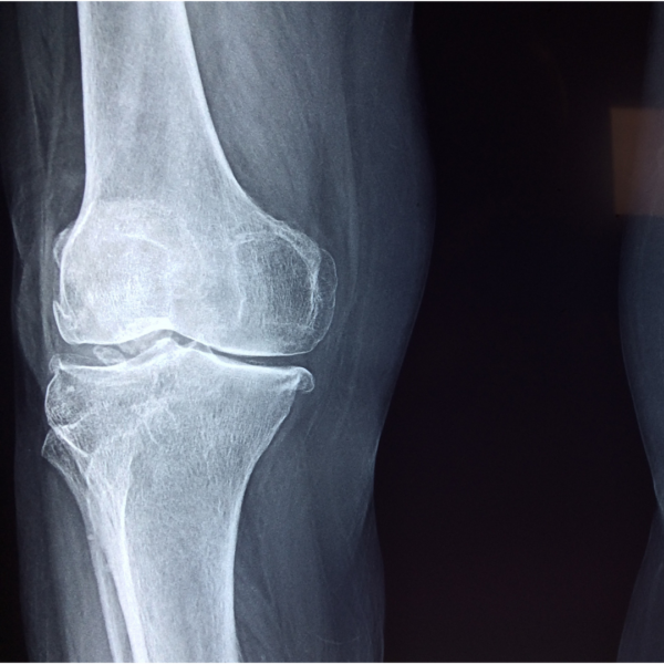 Arthritis? That’s just right…